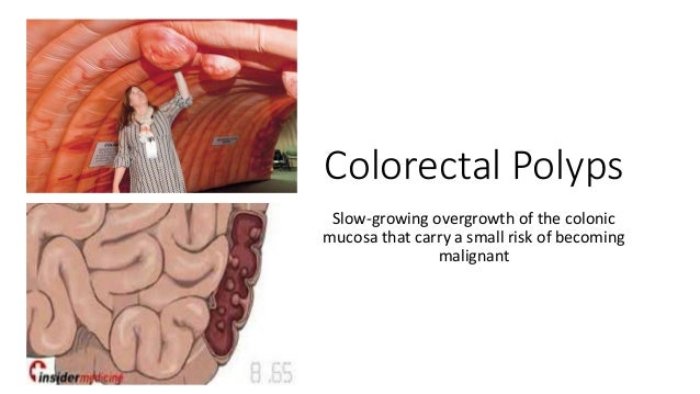 anal picture polyp Gif student anal